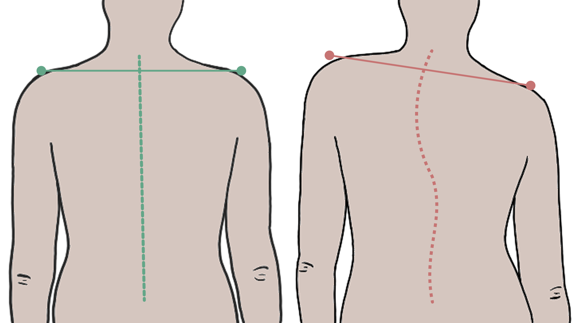 -#0040 {1920x1080}: (asymmetry-posture.png) [асимметрия плеч]