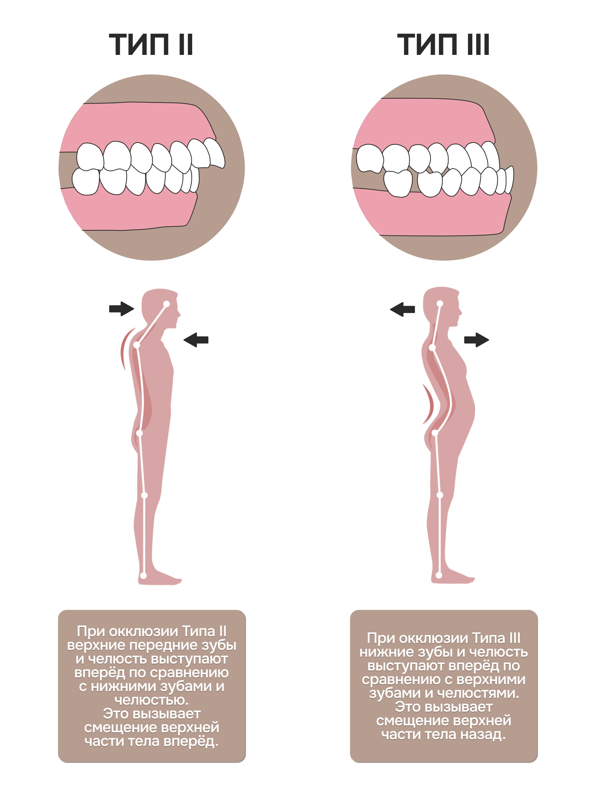 -#0030 {1920x2574}: (posture-types-1-2.png) [связь осанки и прикуса]