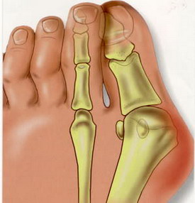 Артрит артроз пальцев ног лечение
