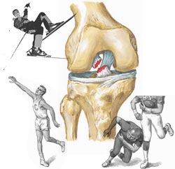 Травма передней крестообразной связки коленного сустава